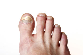 Toenail fungus treatment in the Cook County, IL: Chicago, Evanston, Skokie, Wilmette, Winnetka, Morton Grove areas