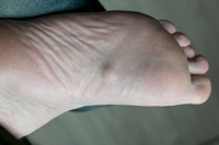 Risk Factors of Plantar Fibromas